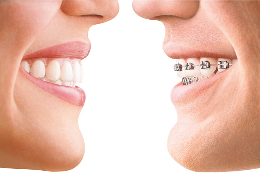 invisalign-comparison-min